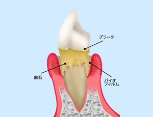 歯周病は日本人が歯を失う原因の第1位です